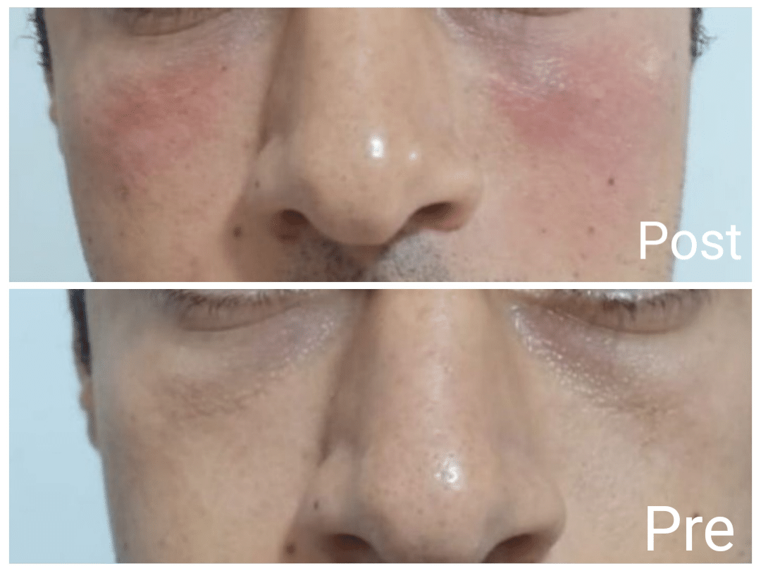 حقن الفيلر في الغردقة لتحسين مظهر الهالات السوداء عند الرجال